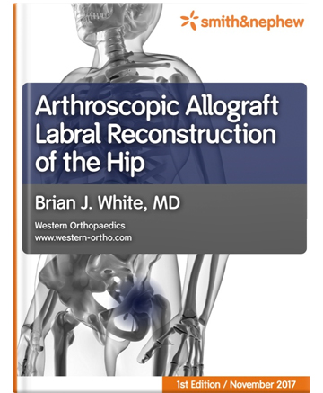 Arthroscopic Allograft Labral Reconstructio‪n‬ of the Hip