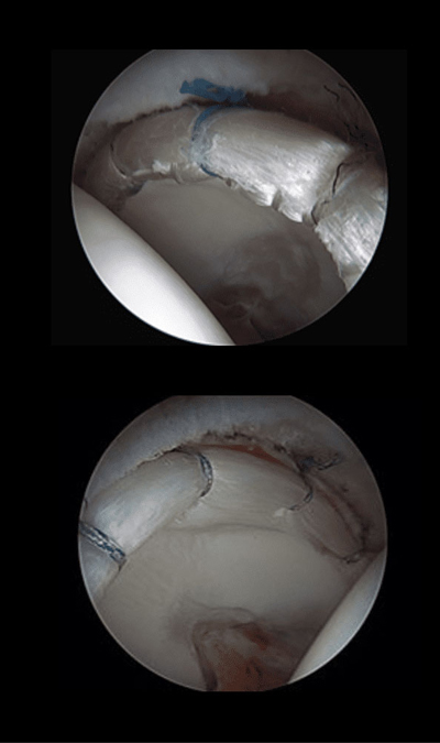 Labral Reconstruction after surgery. 
