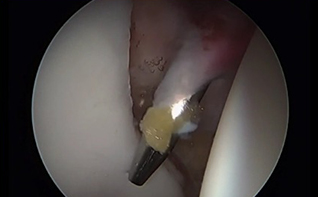 How to Safely Place Anchors Around the Entire Acetabulum