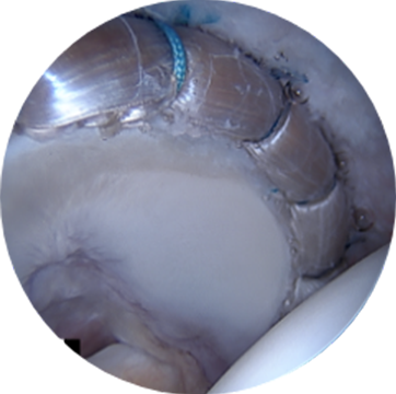 Labral Reconstruction