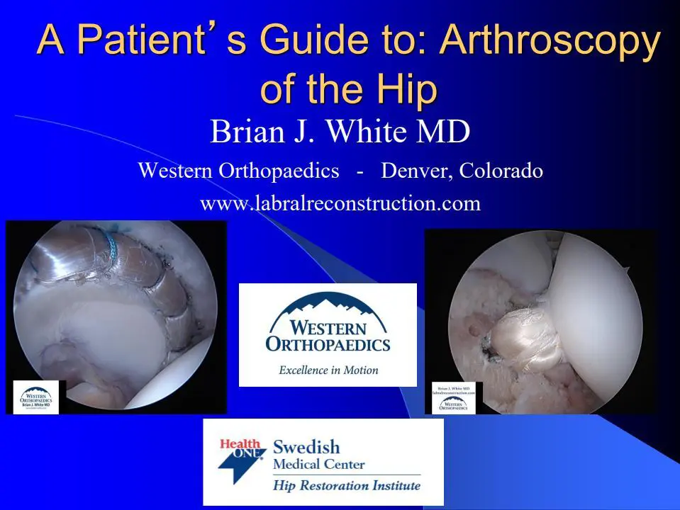 Educational guide explaining hip arthroscopy procedures by Dr. Brian White, orthopedic surgeon specializing in hip preservation and labral reconstruction.