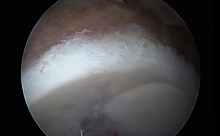 Arthroscopic Allograft Labral Reconstruction Technique: ISHA Meeting, Cambridge, England 2015