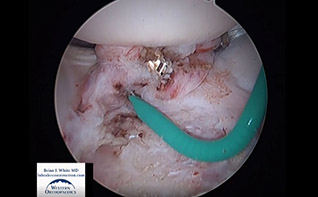 Ligamentum Teres Reconstruction ISHA 2022