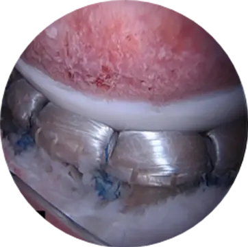 Labral Reconstruction