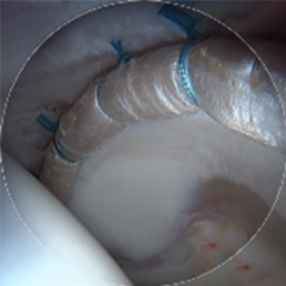 Labral Reconstruction