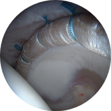 Labral Reconstruction