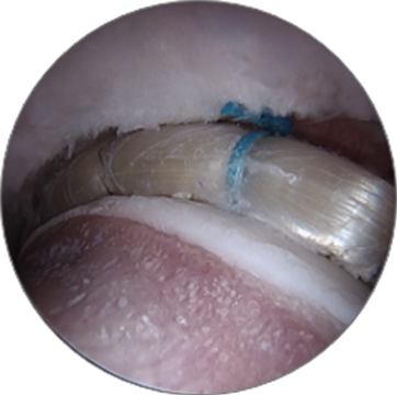 Labral Reconstruction