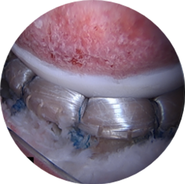 Labral Reconstruction